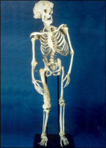 Joseph Carey Merrick's skeleton